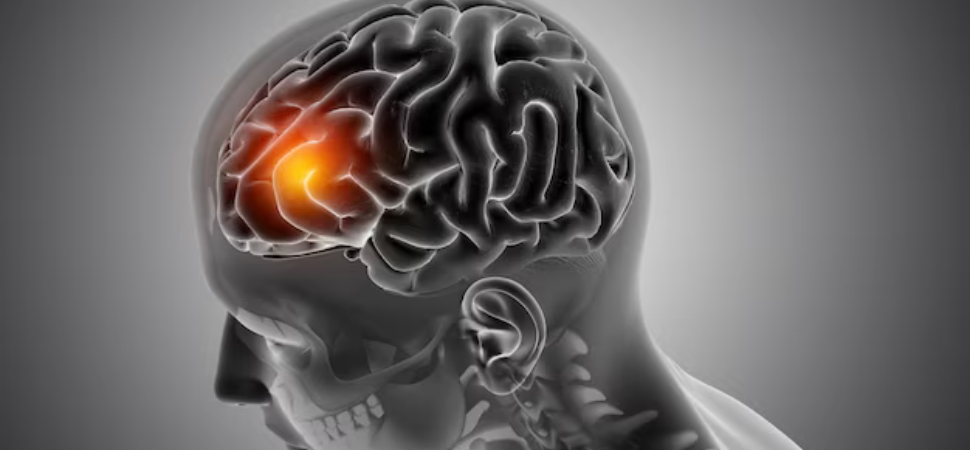 Brain Tumor